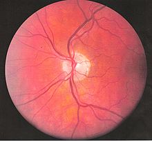 A left eye vessels