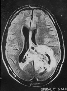 Non-contrast magnetic resonance imaging showing hyper-intense lesion involving the left temporal and parieto-occipital regions. The tumor is crossing the midline to the right parietal region.