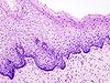 Cervical intraepithelial neoplasia (1) normal squamous epithelium.jpg