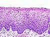 Cervical intraepithelial neoplasia (3) CIN2.jpg