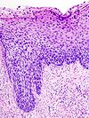 Cervical intraepithelial neoplasia (4) CIN3.jpg