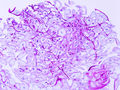 Esophageal candidiasis (1) PAS stain.jpg