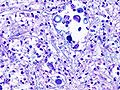 Pulmonary cryptococcosis (3) Alcian blue-PAS.jpg