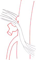 Median arcuate ligament syndrome anatomy.png