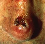 Squamous Cell Carcinoma1.jpg