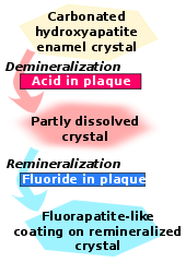 Carbonated hydroxyapatite enamel crystal is demineralized by acid in plaque and becomes partly dissolved crystal. This in turn is remineralized by fluoride in plaque to become fluorapatite-like coating on remineralized crystal