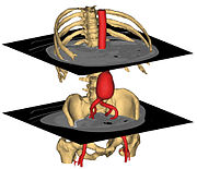 3D surface models from abdominal CT .jpg