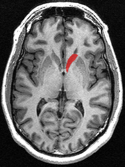 This is a transverse view of the caudate nucleus from a structural MR image.