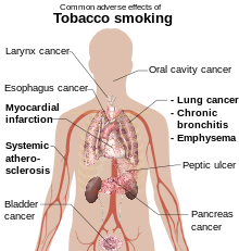 head and torso of a male with internal organs shown and labels referring to the effects of tobacco smoking
