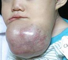 A child with a massive ameloblastoma of the mandible