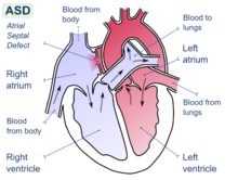 Diagram of the four chambers of the heart. There is a gap in the wall between the upper-left and upper-right chambers