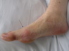 side view of a foot showing a red patch of skin over the joint at the base of the big toe