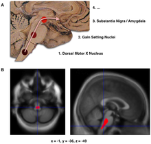 Composite of three images, one in top row (described in caption as A), two in second row (described in caption as B). Top shows a mid-line sagittal plane of the brainstem and cerebellum. There are three circles superimposed along the brainstem and an arrow linking them from bottom to top and continuing upward and forward towards the frontal lobes of the brain. A line of text accompanies each circle: lower is "1. Dorsal Motor X Nucleus", middle is "2. Gain Setting Nuclei" and upper is "3. Substantia Nigra/Amygdala". A fourth line of text above the others says "4. ...". The two images at the bottom of the composite are magnetic resonance imaging (MRI) scans, one saggital and the other transverse, centred at the same brain coordinates (x=-1, y=-36, z=-49). A colored blob marking volume reduction covers most of the brainstem.