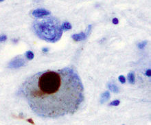 Several brain cells stained in blue. The largest one, a neurone, with an approximately circular form, has a brown circular body inside it. The brown body is about 40% the diameter of the cell in which it appears.