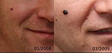 Evolution of a 4mm nodular melanoma.