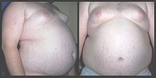 A front and side view of a "super obese" male torso. Stretch marks of the skin are visible along with gynecomastia.