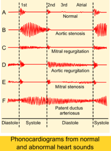 Phonocardiograms from normal and abnormal heart sounds.png