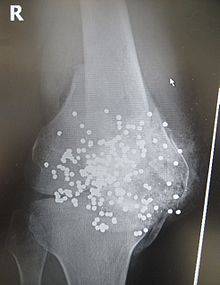 Radiograph of a close-range shotgun blast injury to the knee. Birdshot pellets are visible within and around the shattered patella, distal femur and proximal tibia.