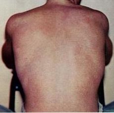 Photograph of a person's back with the skin exhibiting the characteristic rash of dengue fever