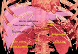 3D rendered CT of abdominal aortic branches and kidneys.png
