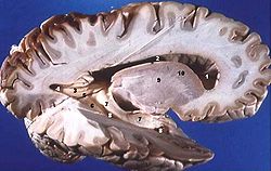 Human brain right dissected lateral view description.JPG