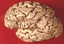 Human brain view on transverse temporal and insular gyri description.JPG