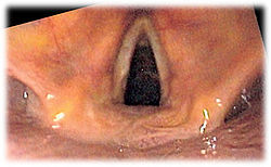 Larynx endo 2.jpg