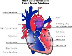 Patent ductus arteriosus.jpg
