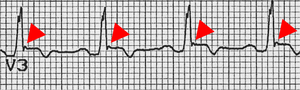 EKG lead demonstrating the epsilon wave