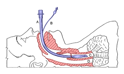 Diagram of an endotracheal tube that has been inserted into the airway