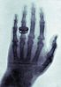 X-ray of the hand of W. Röntgen's wife
