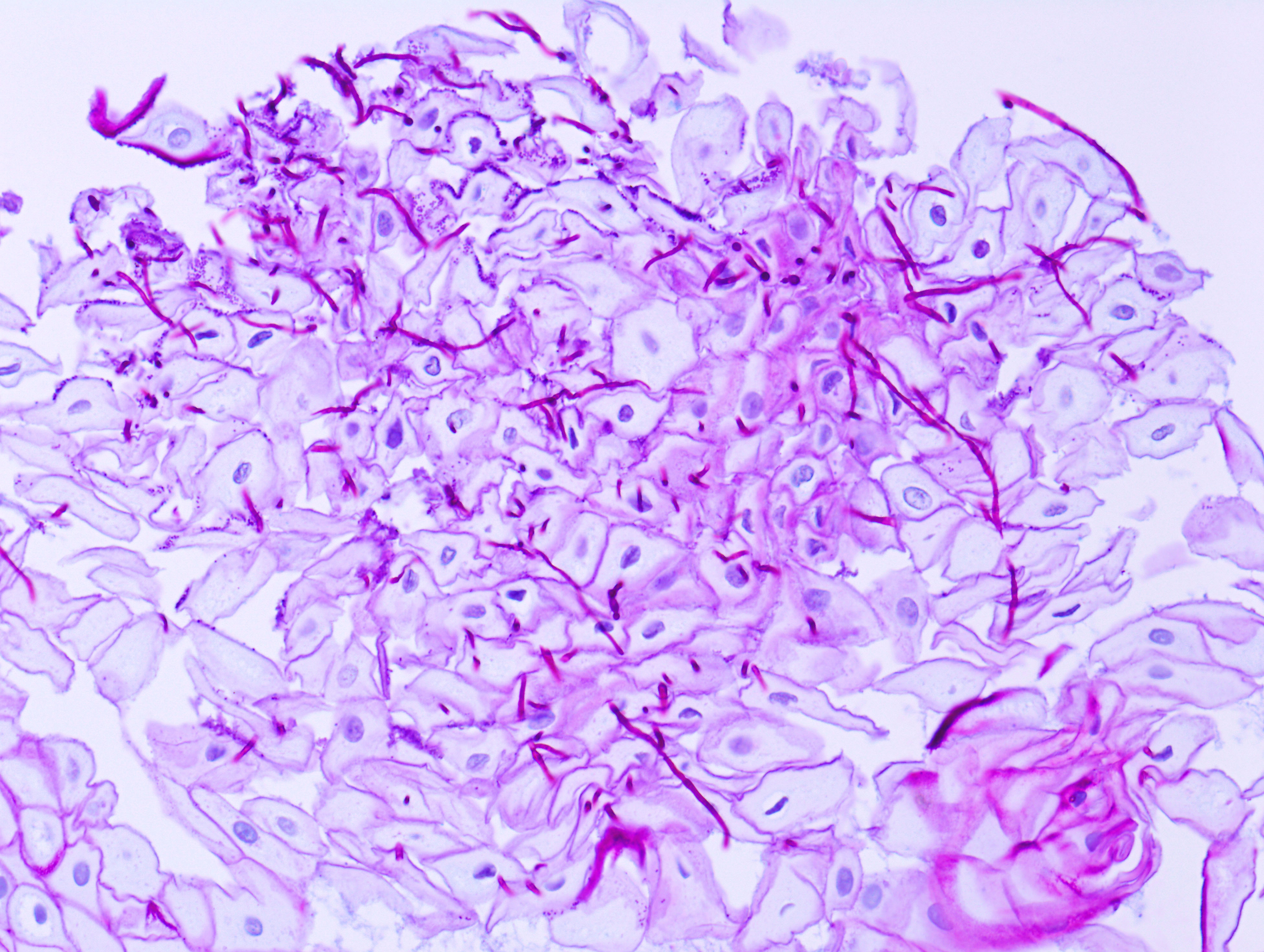 esophageal-candidiasis