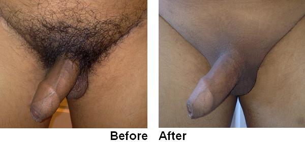 is the practice of male pubic hair removal. 